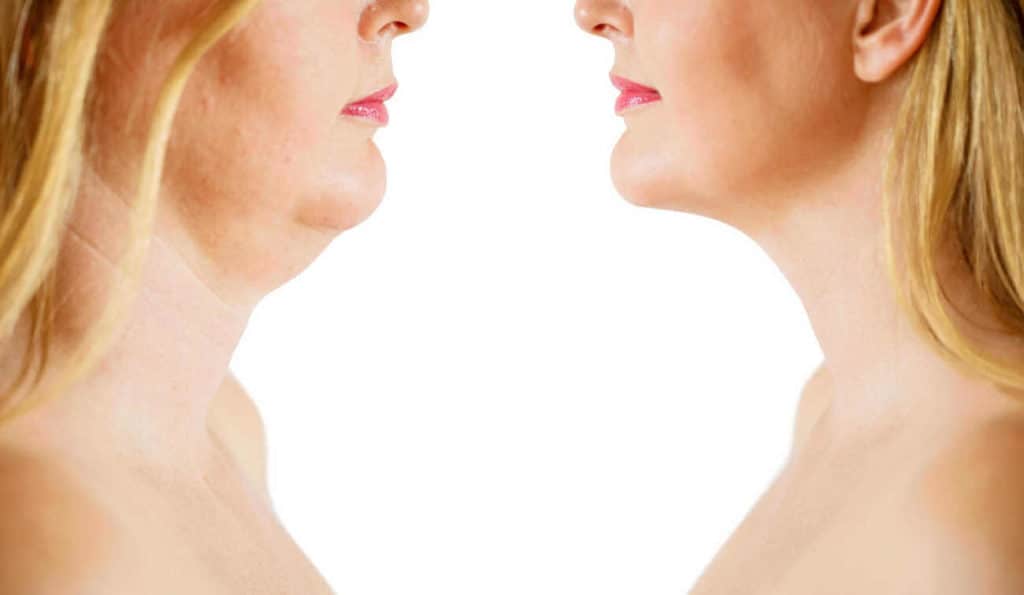 Double Chin treatment East Bedfont before and after results