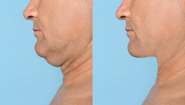 Which Non-Surgical Treatments Work Best for Jowls and Loose Skin East Bedfont?