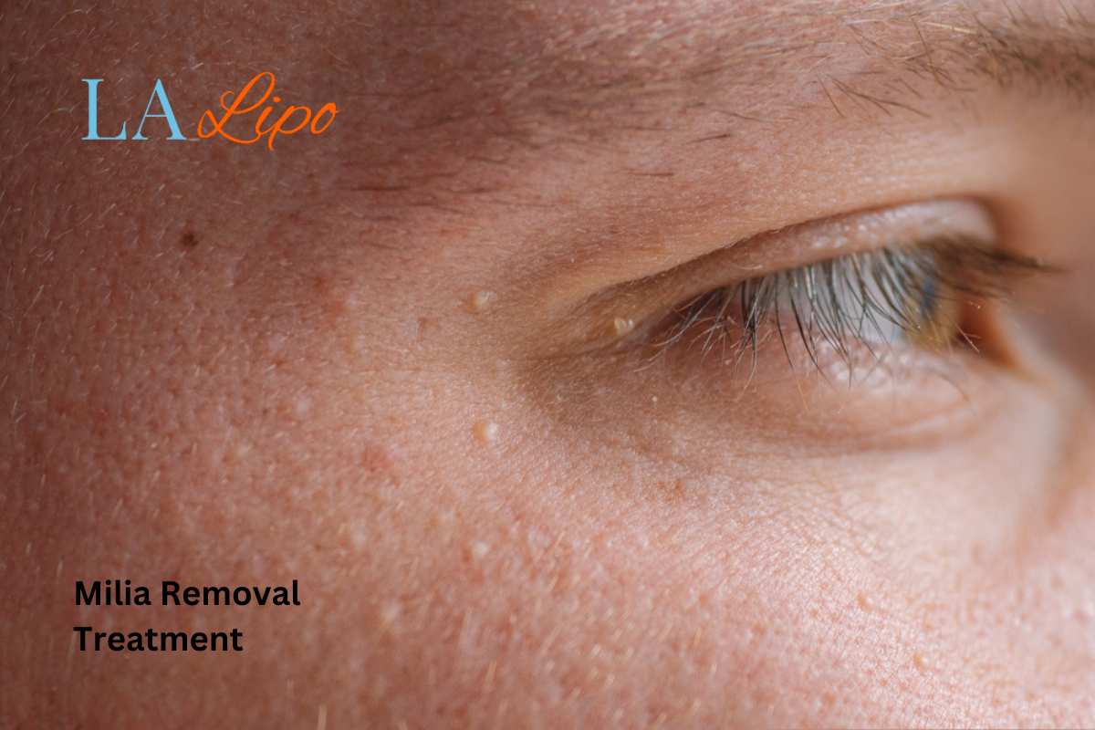 Cryopen Milia Removal: Is It the Easiest and Safest Option East Bedfont?