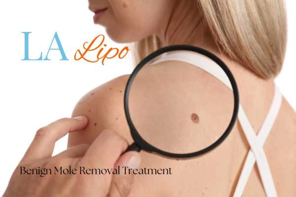 Woman having her inspection of blemish before mole removal East Bedfont