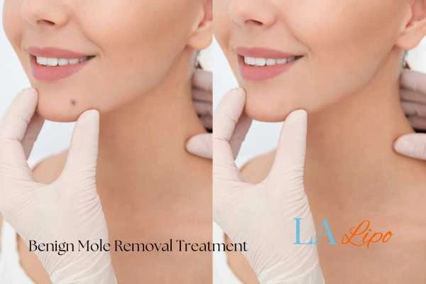 woman's before and after mole removal East Bedfont results