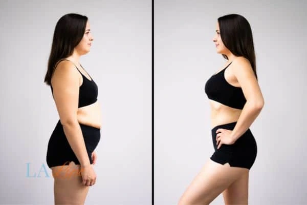 image of woman before and after results of LA-EMS Body Sculpting East Bedfont to help treat Diastasis recti