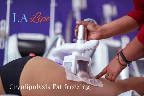 women getting fat freezing East Bedfont