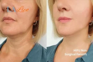 hi-fu for wrinkles East Bedfont before and after results