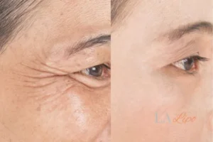 Before and after results of woman - HI-fu wrinkles reduction treatment East Bedfont