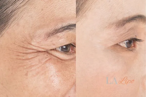Before and after results of woman - HI-fu wrinkles reduction treatment East Bedfont