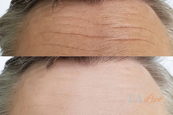 results of HIFU East Bedfont on mans forehead to help reduce lines and wrinkles