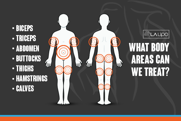 Graphic to show areas you can have LA-EMS Body Sculpting East Bedfont treatment.