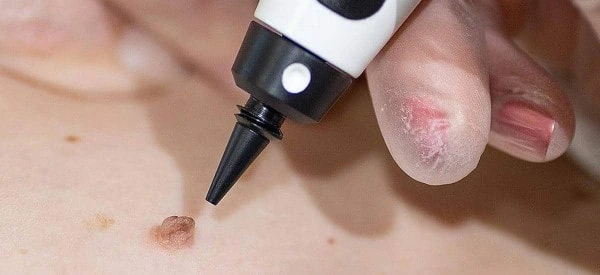 skin tag removal using cryopen East Bedfont