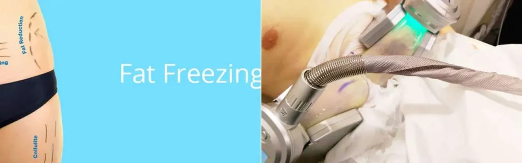 Fat freezing East Bedfont on multiple areas of the body