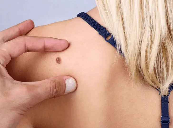woman having mole removal East Bedfont consultation before treatment.