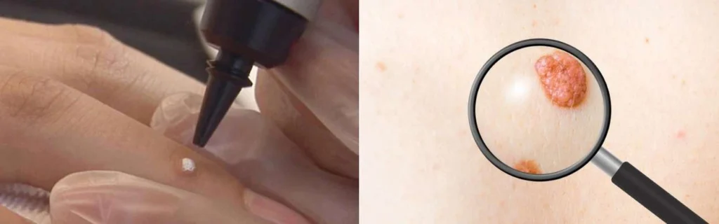 CryoPen practitioner East Bedfont assessing a benign mole before treatment