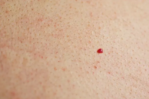close up of a cherry angioma East Bedfont