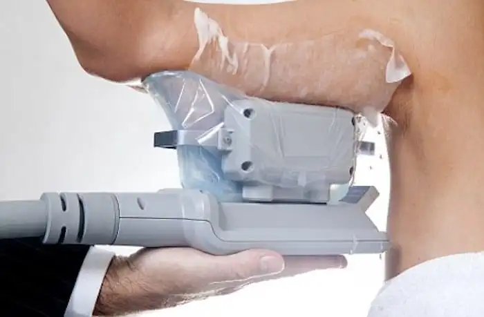 Picture of fat freezing East Bedfont on the upper arms.