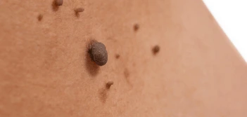 image of a skin tag East Bedfont
