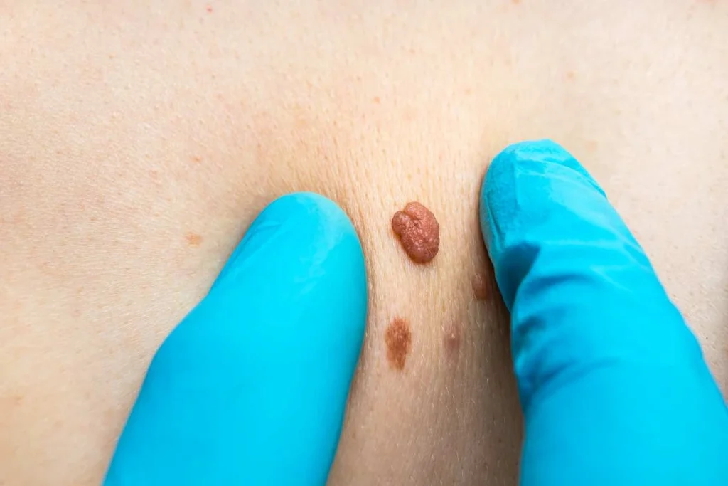 Consultant examining a skin tag East Bedfont