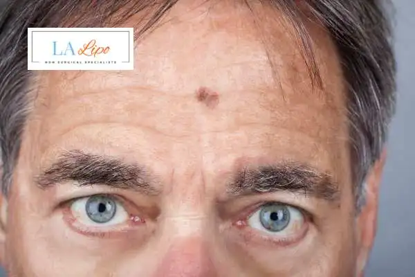 Solar Lentigo Removal East Bedfont image of man with mark on his forehead