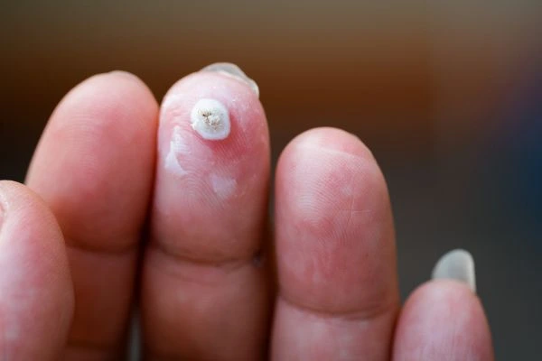 wart on person finger - cryotherapy to treat from LA LIPO East Bedfont