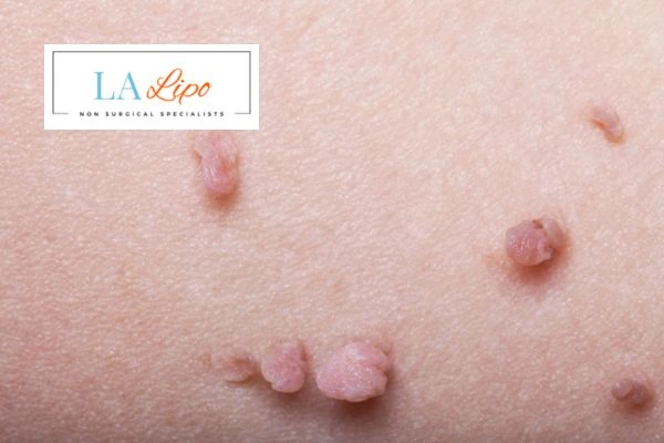 Does cryopen skin tag removal East Bedfont hurt? Find out now call our team today!
