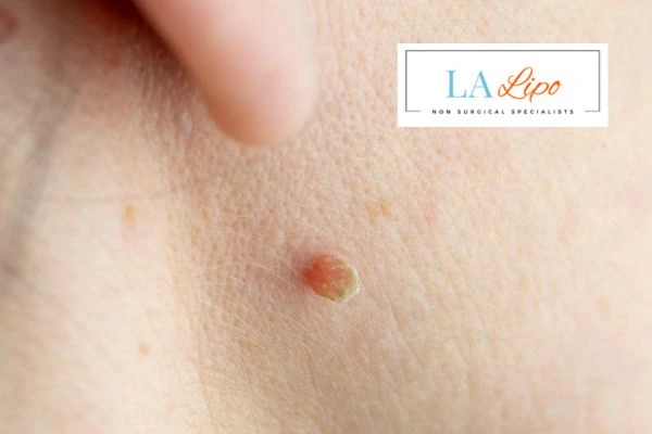 Book skin tag removal East Bedfont today speak to our team now!