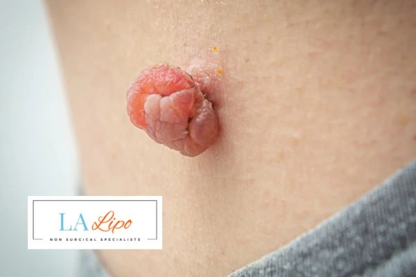 Interested in skin tag removal East Bedfont? Concerned about the pain? Find out more today!
