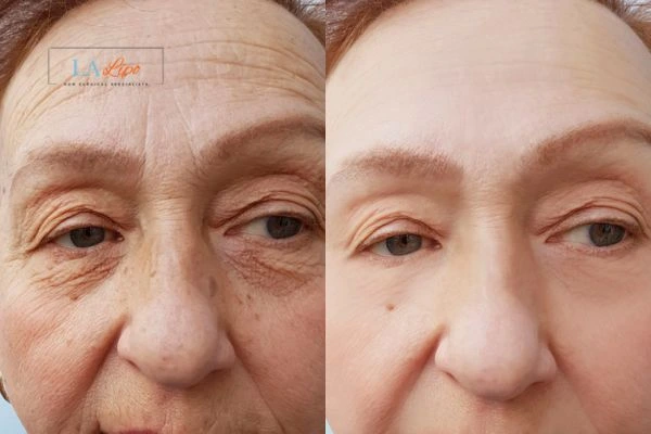 The powerful benefits of Morpheus8 Treatment East Bedfont - Call Our team today!
