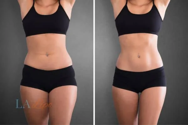 before and after results of non-surgical treatment to help a woman's body image and mental health East Bedfont