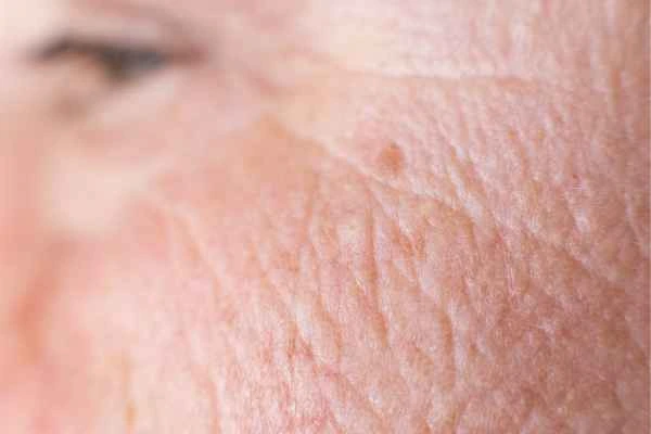 close up picture of a woman's face showing an age spot East Bedfont