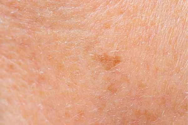 close up picture of age spots East Bedfont