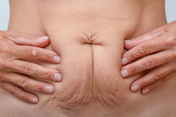 Image of a woman's stomach with loose skin - example of skin tightening East Bedfont options