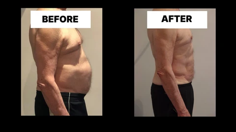 What Symptoms Can Diastasis Recti Cause in Men? Weak Core, Back Pain and Poor Posture East Bedfont